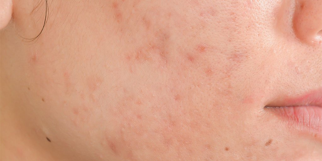 Larocheposay ArticlePage Acne How to get rid of scars and marks